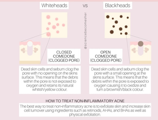 Understanding Acne