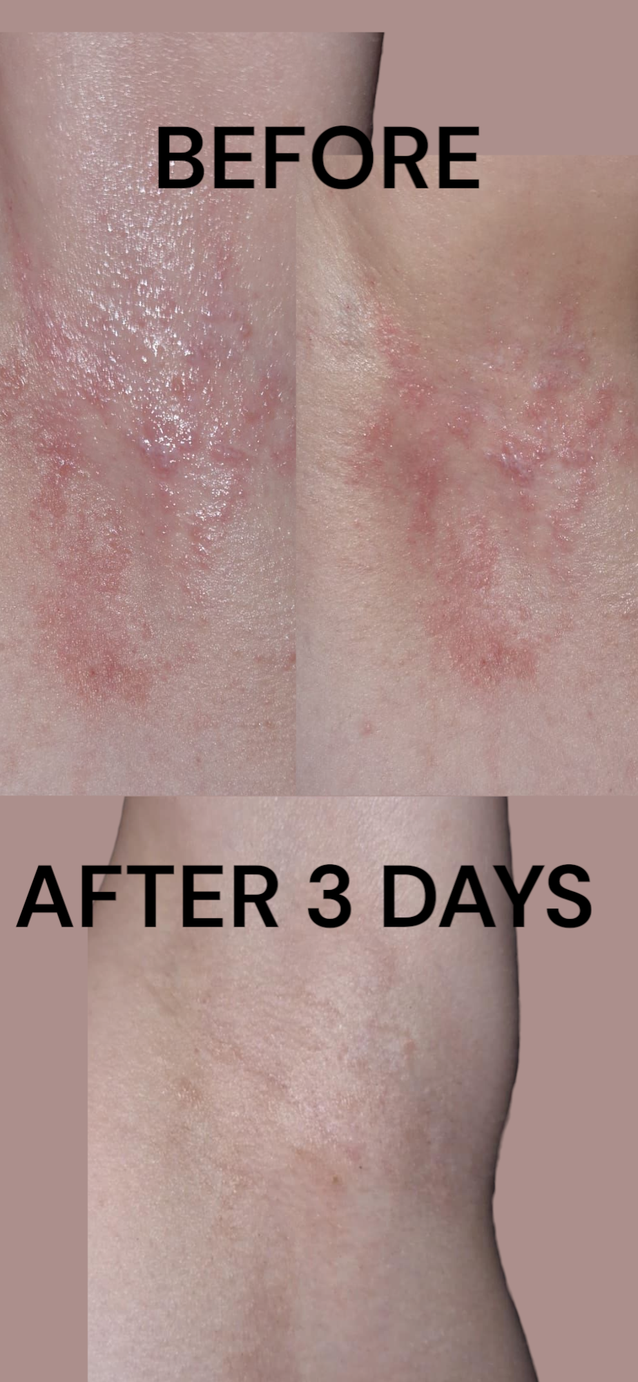 Before and after 3 days using Charcoal & Oat Cream showing skin improvement.