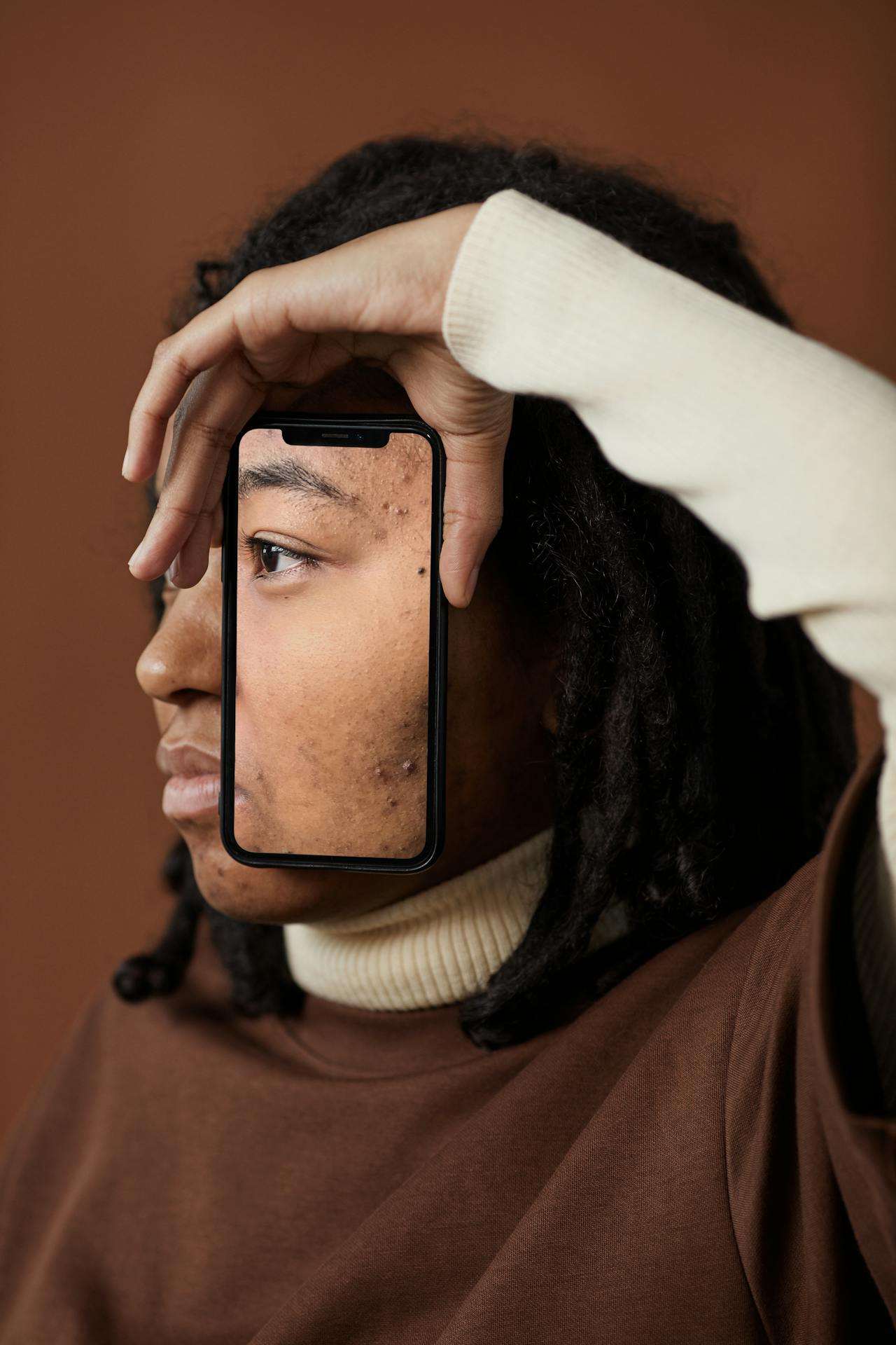 Acne-Prone