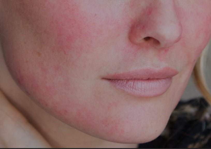 Skin Redness Collection - Timeless Beauty Cosmetics