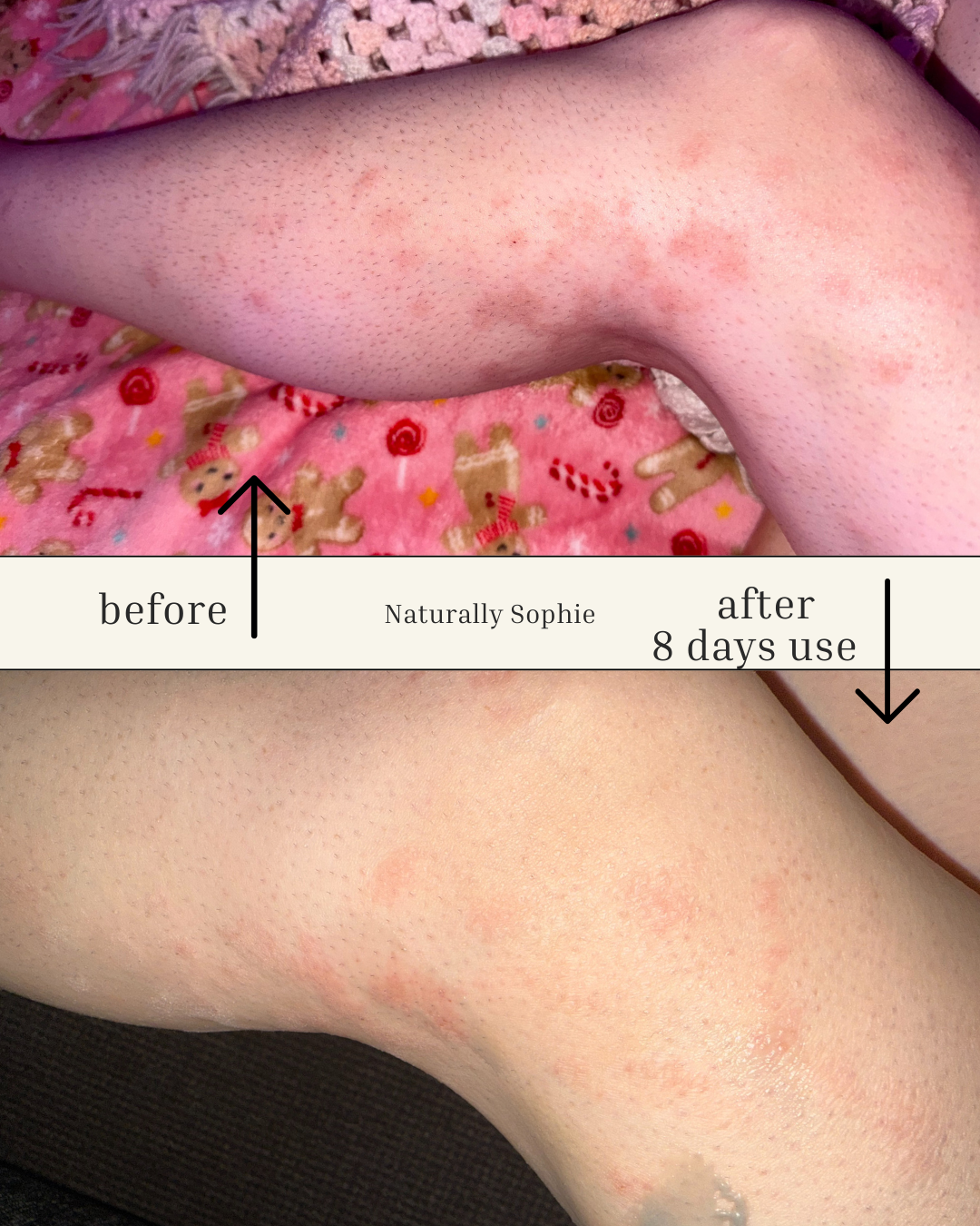 Blackseed & Blue Tansy Skin Rescue renewal Balm - Naturally Sophie Before and after comparison of skin treated with skin rescue balm and the  Charcoal & Oat Cream with 8 days of treatment 