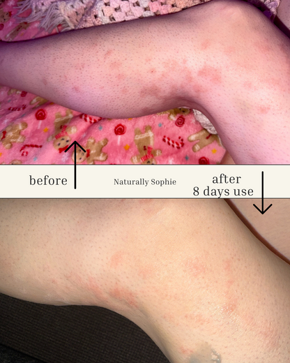 Blackseed & Blue Tansy Skin Rescue renewal Balm - Naturally Sophie Before and after comparison of skin treated with skin rescue balm and the  Charcoal & Oat Cream with 8 days of treatment 